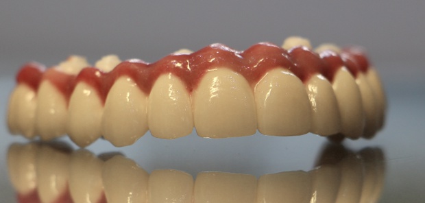 Okluzálisan csavarozott felső cirkónium kőrhíd műínnyel-2