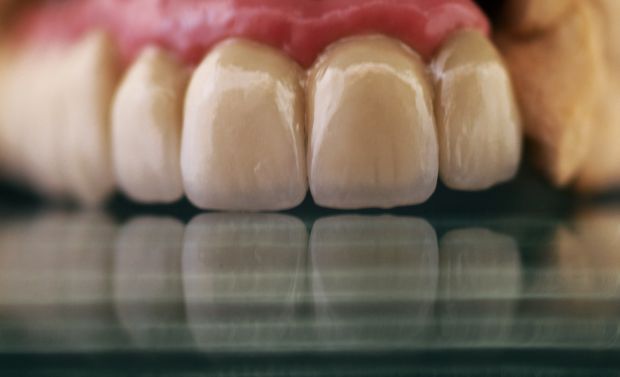 Felső, implantátumos, ragasztott, fémkerámia híd-2