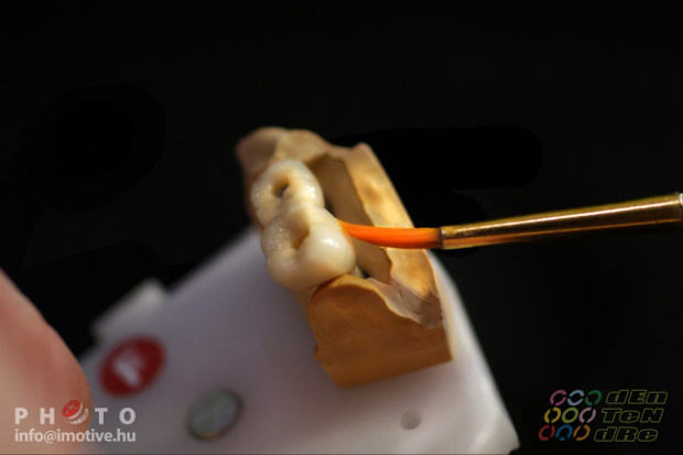 Csavaros rögzítésű cirkon implantátum koronák​-5