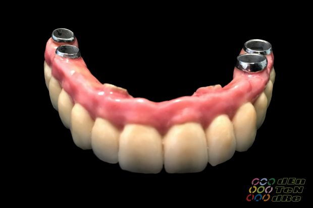 Intraocclusalisan csavarozott teljes felső implantátumos rehabilitáció matt próbán és átadáskor