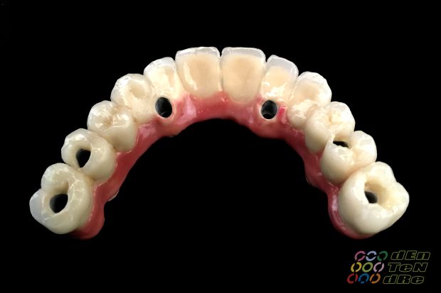 Intraocclusalisan csavarozott teljes felső implantátumos rehabilitáció matt próbán és átadáskor-2
