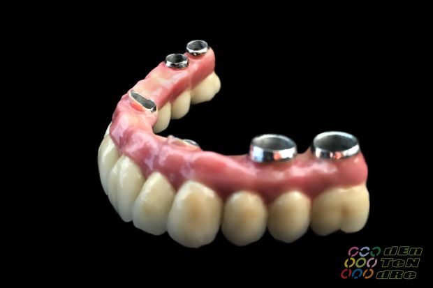 Intraocclusalisan csavarozott teljes felső implantátumos rehabilitáció matt próbán és átadáskor-3