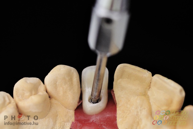 Csavaros rögzítésű implantátumos cirkonkerámia szóló korona.-3