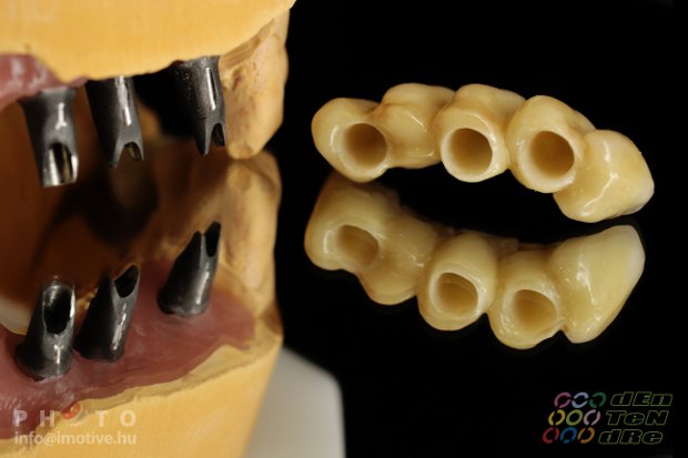 Implantátumos cirkonkerámia front híd lengőtaggal, csavaros rögzítésű cirkonkerámia szóló korona-2