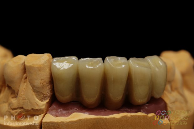 Implantátumos cirkonkerámia front híd lengőtaggal, csavaros rögzítésű cirkonkerámia szóló korona-3