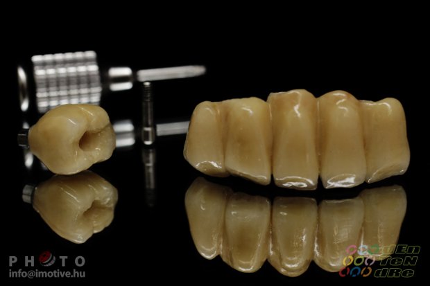Implantátumos cirkonkerámia front híd lengőtaggal, csavaros rögzítésű cirkonkerámia szóló korona-4
