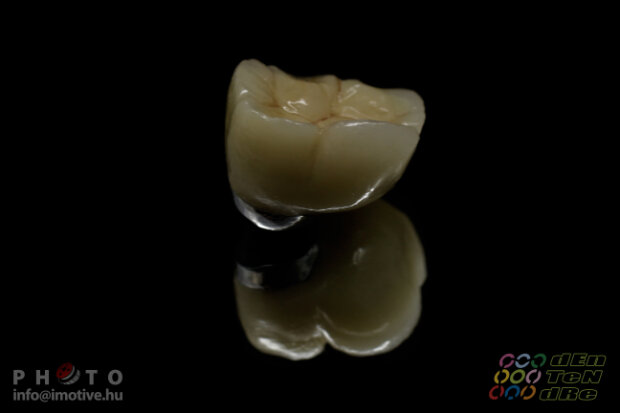 Alsó implantátumos szóló fémkerámia korona-3