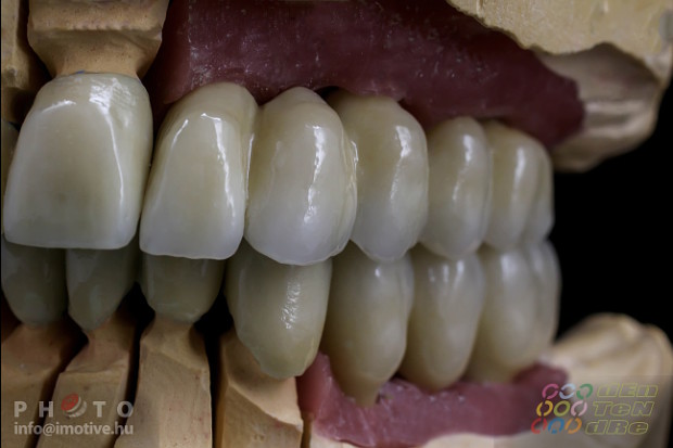 Alsó - felső implantátumos fémkerámia körhíd.-4