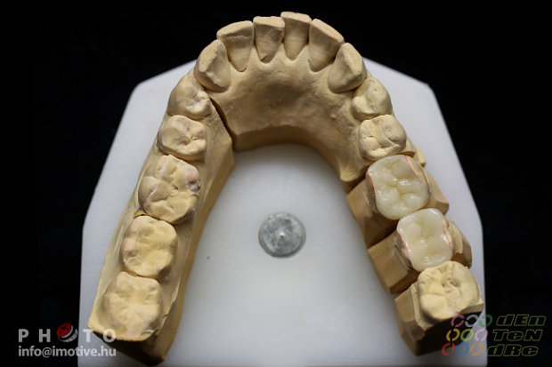 Emax Prés Inlay-4
