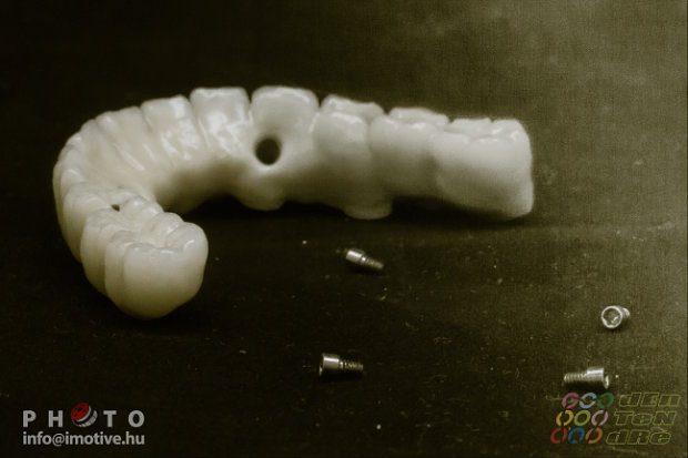 Alsó implantátumos fémkerámia körhíd, Felső lokátoros fogsor-5