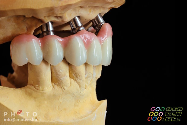 Felső implantátumos fémkerámia körhíd, kerámia műínnyel.-2