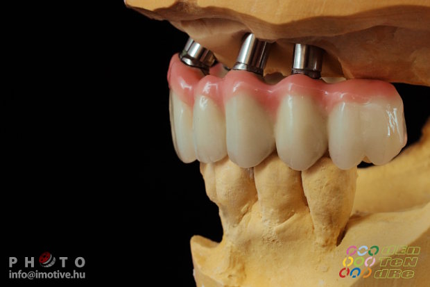Felső implantátumos fémkerámia körhíd, kerámia műínnyel.-3